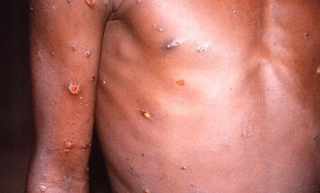 Lesões na pele de quem sofre de varíola. (Foto: CDC-Brian W.J. Mahy/Agência Brasil/ReproduçãoSecretaria de Estado de Saúde MS) 